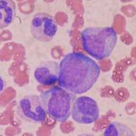 Researchers find new, safer treatment for serious side effect of bone marrow transplant